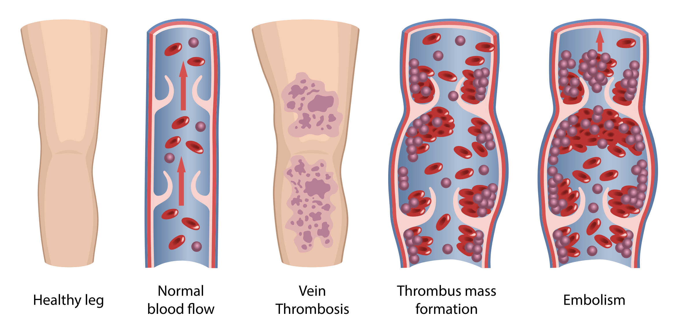 Deep Vein Thrombosis – Laser Vascular Center