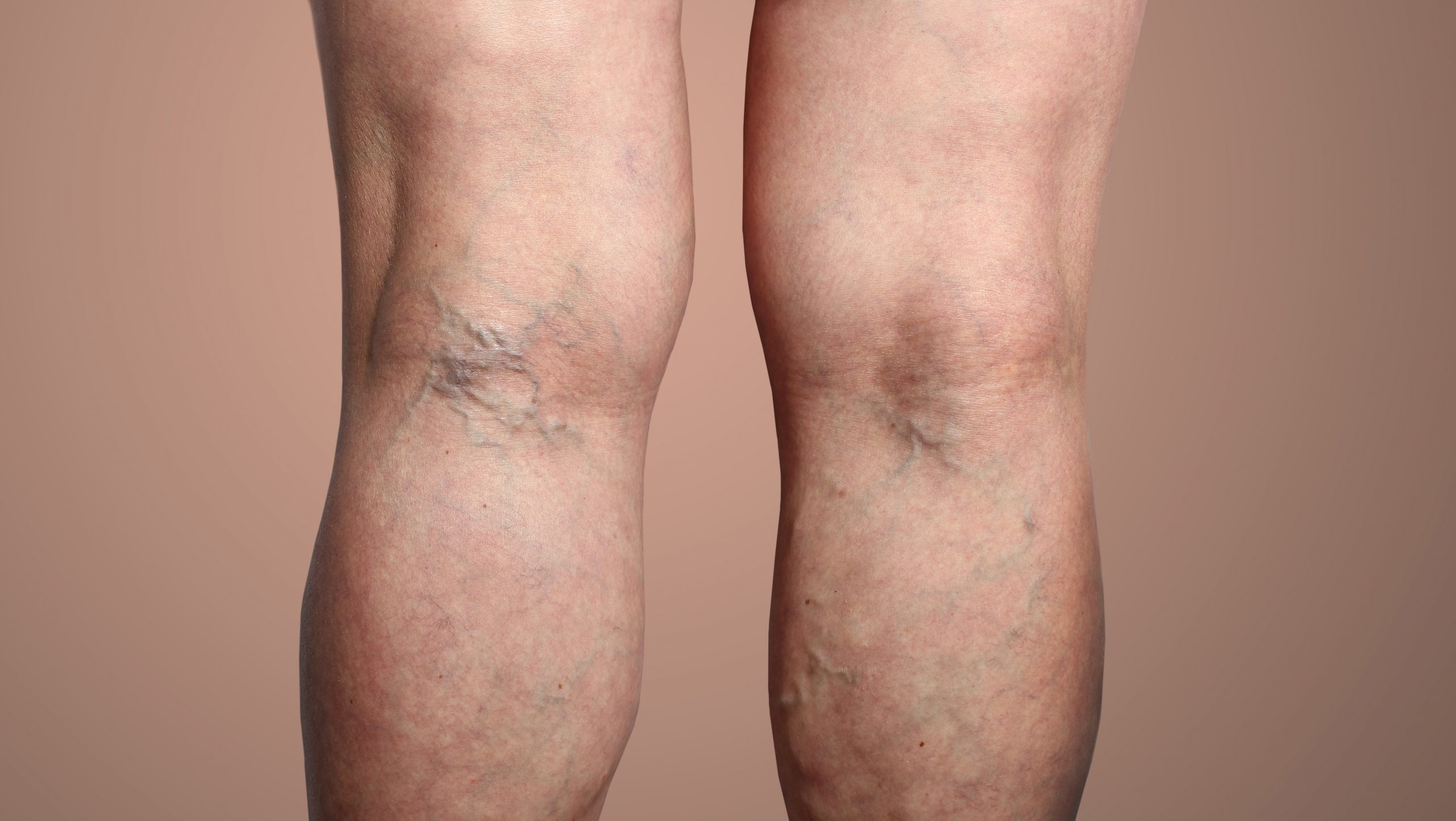 Are Varicose Veins Dangerous? What Are The Symptoms & Treatments?