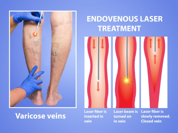 Are Varicose Veins Dangerous? What Are The Symptoms & Treatments