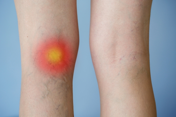 Are Varicose Veins Dangerous? What Are The Symptoms & Treatments