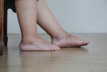 Lymphedema
