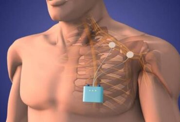 Peripheral Neuropathy Stimulator (PNS