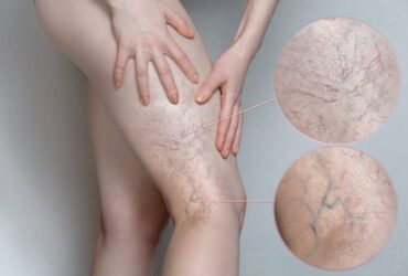 Spider Veins