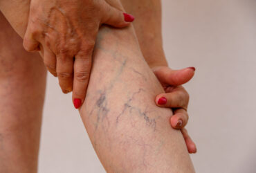 varicose veins of eldelry woman.