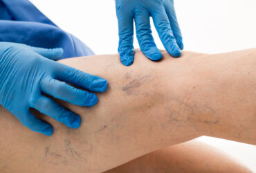 Venous Insufficiency