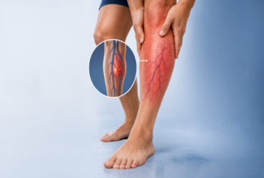 deep-vein-thrombosis-dvt-Condition-Overview