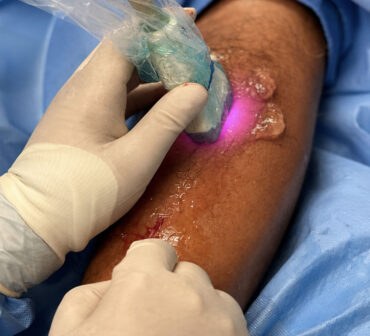EVLT (Endovenous Laser Treatment)