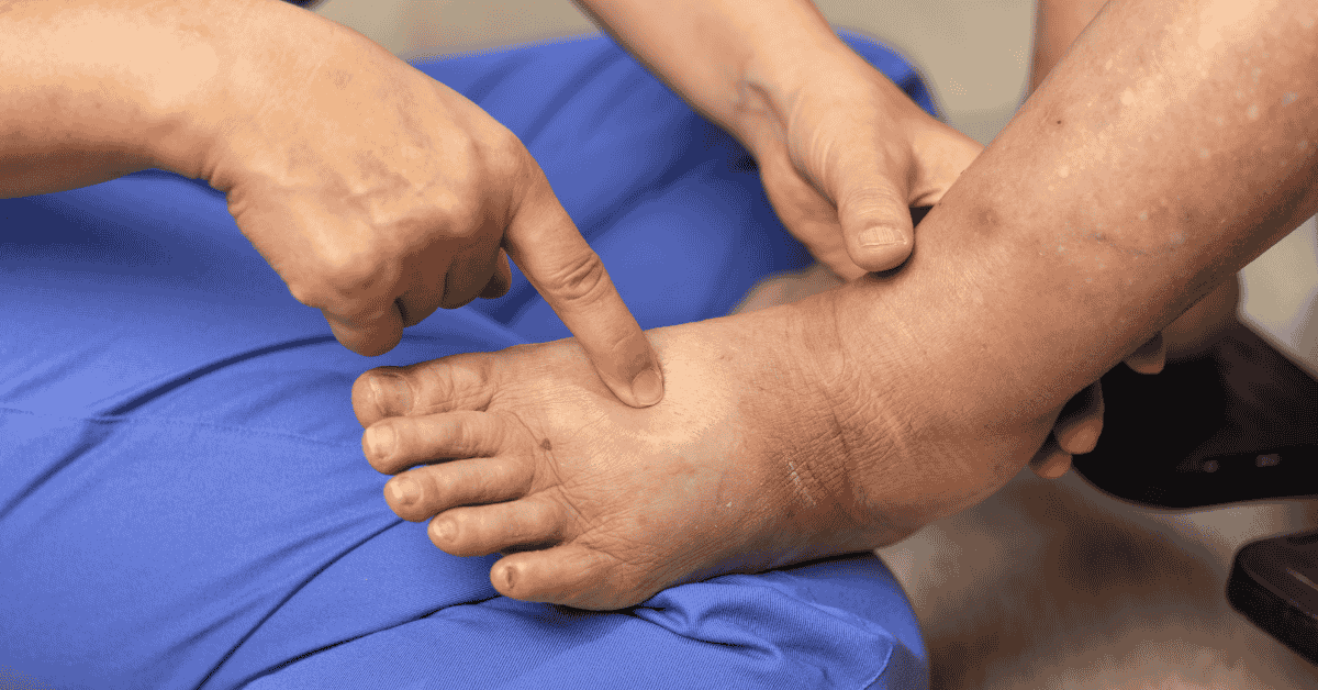 Leg Swelling Isn’t Just Fatigue: When to Worry About Your Circulation