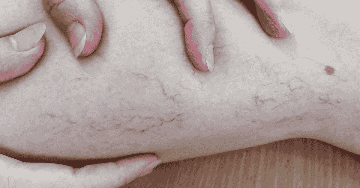 Varicose Veins vs. Spider Veins: What’s the Difference and When Should You See a Vascular Specialist?