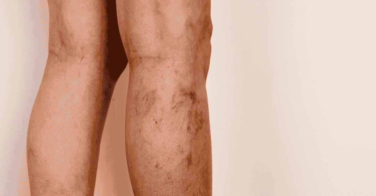 Spider Veins Came Back After Treatment? Here’s What Might Be Missing