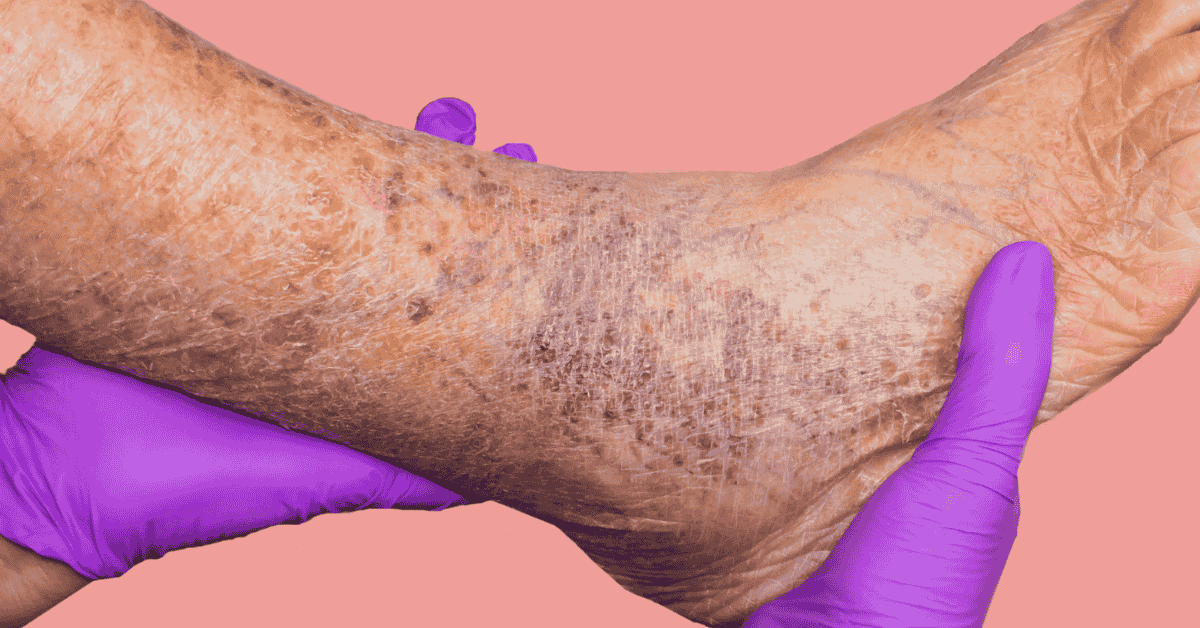 When Varicose Veins Become a Medical Problem — Not Just a Cosmetic One