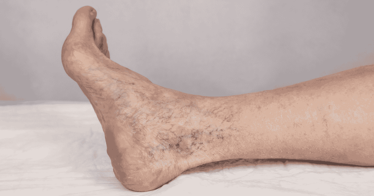 What Really Causes Varicose Veins? Genetics, Lifestyle, and Circulation Explained