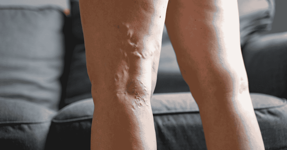 Spider Veins vs. Varicose Veins: What’s the Difference — and When Is It Medical?