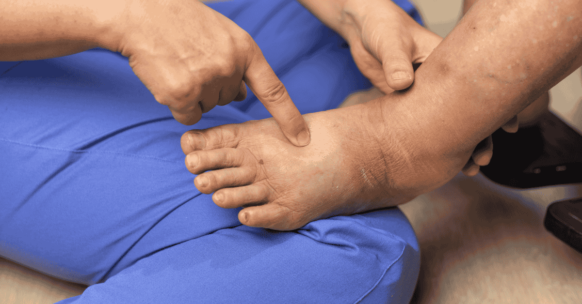 Why Do My Legs Swell at the End of the Day? Common Circulatory Causes Explained