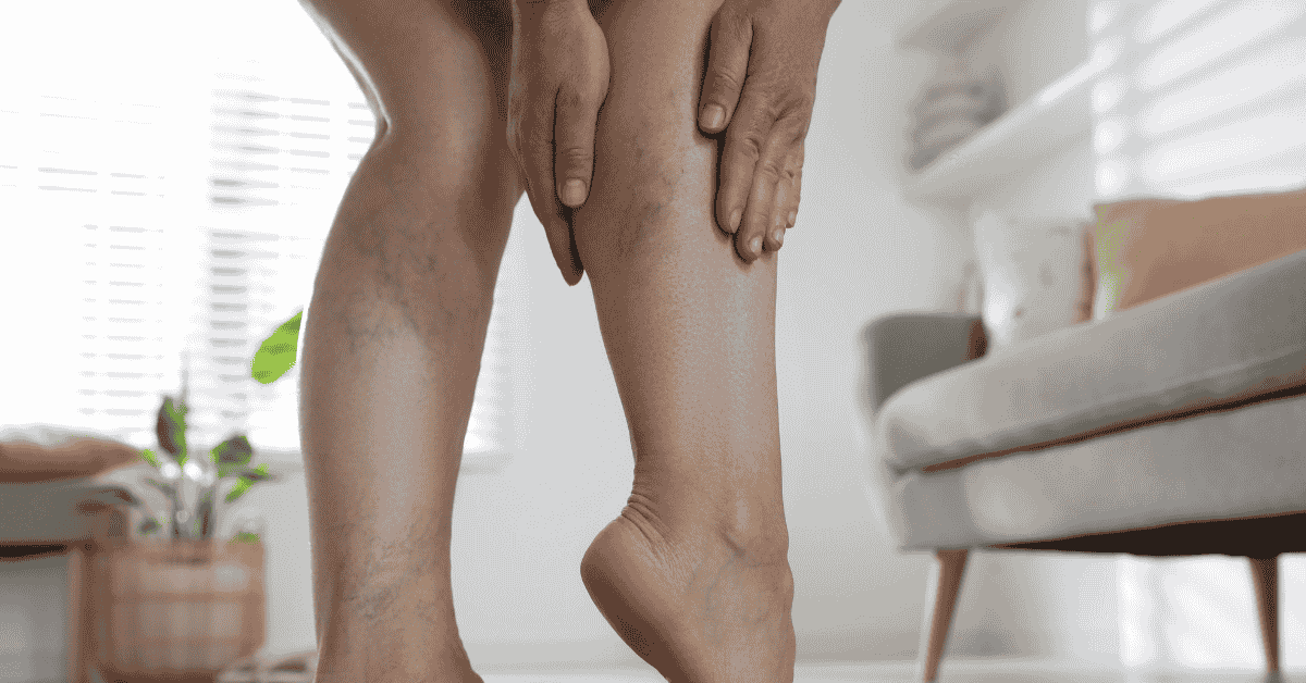 The “Leg Fatigue” Trap: Why So Many People Misdiagnose Their Own Vein Problems