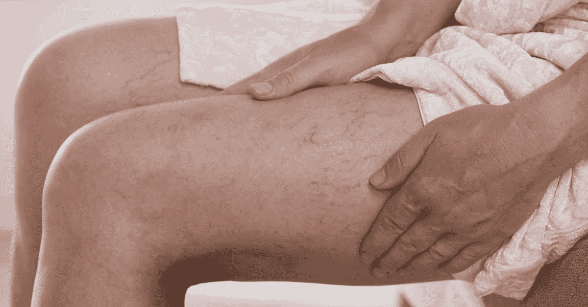 From Cosmetic Concern to Medical Condition: When Veins Become a Health Issue