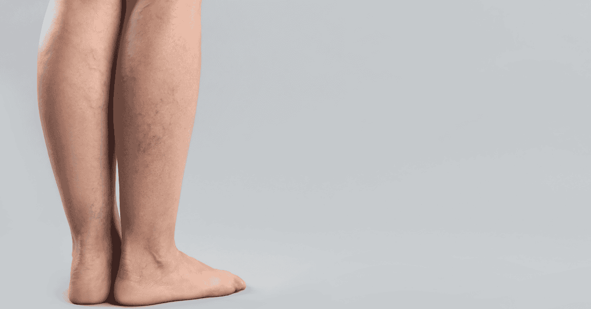 Are Your Legs Trying to Warn You? Subtle Symptoms Most People Ignore