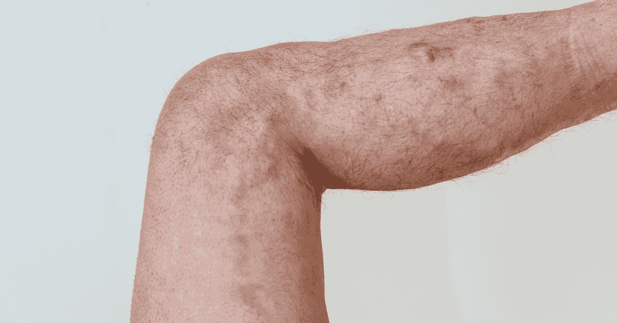 What Happens If You Ignore Varicose Veins for 5, 10, or 20 Years?