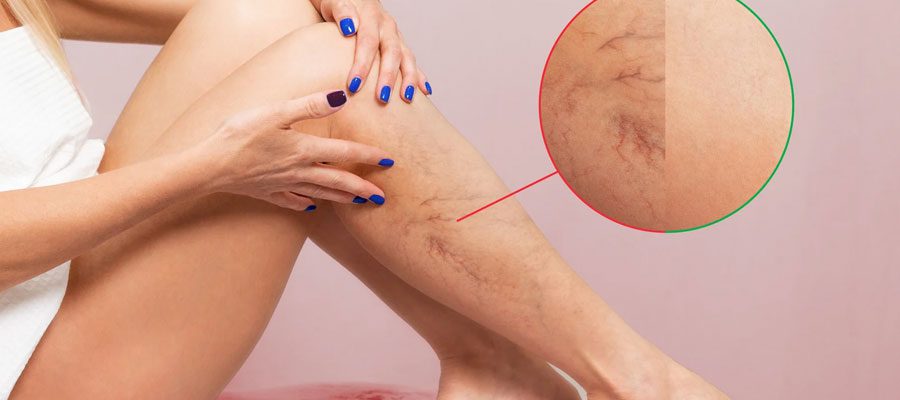 Varicose Veins Treatment in Phoenix: When Should You See a Vascular Specialist? Varicose Veins Treatment in Phoenix: When Should You See a Vascular Specialist?